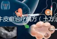 牛皮癬治療偏方(土方治牛皮癬)