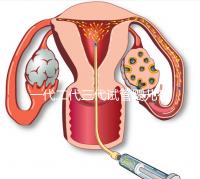 一代二代三代試管嬰兒有什么區(qū)別