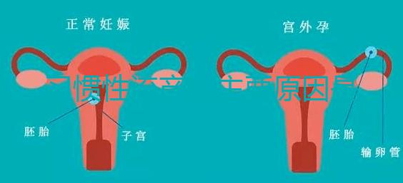 習(xí)慣性流產(chǎn)的主要原因是什么？