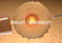 肺癌治療(肺部腫瘤治療最好的醫(yī)院)