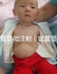 試管顯微注射（試管顯微注射什么藥）